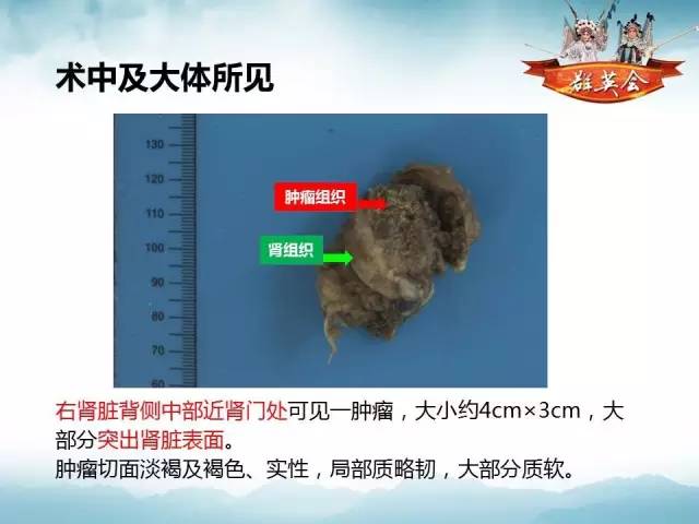 【病例】肾乳头状细胞癌1例CT影像表现