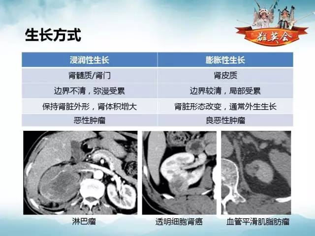 【病例】肾乳头状细胞癌1例CT影像表现