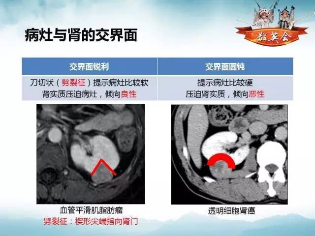 【病例】肾乳头状细胞癌1例CT影像表现