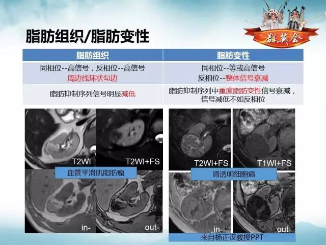【病例】肾乳头状细胞癌1例CT影像表现