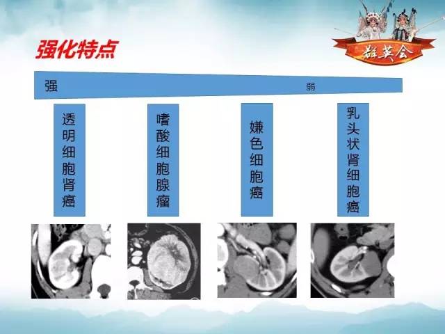【病例】肾乳头状细胞癌1例CT影像表现