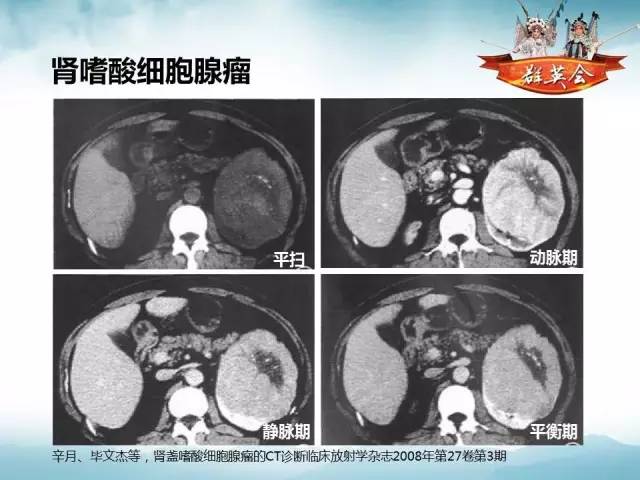 【病例】肾乳头状细胞癌1例CT影像表现