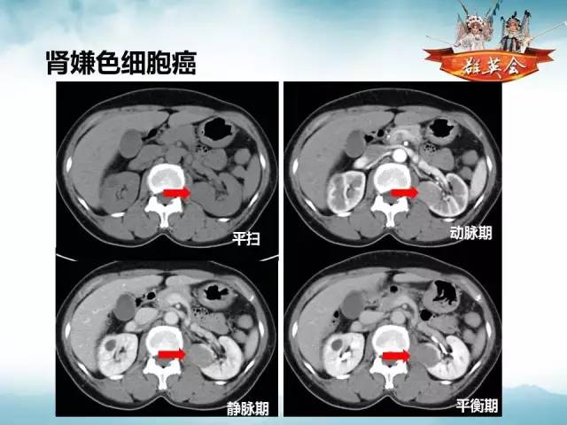 【病例】肾乳头状细胞癌1例CT影像表现