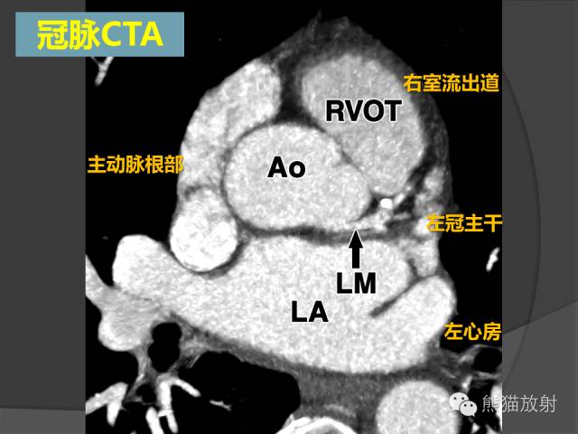 【PPT】冠状动脉解剖 【PPT】冠状动脉解剖