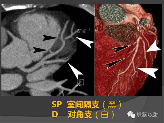 【PPT】冠状动脉解剖 【PPT】冠状动脉解剖