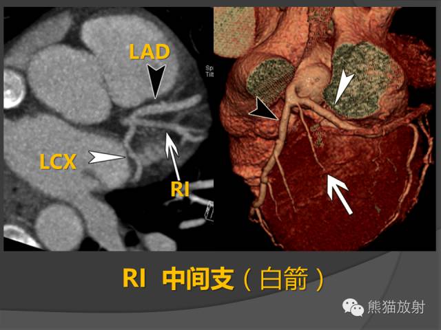 【PPT】冠状动脉解剖 【PPT】冠状动脉解剖