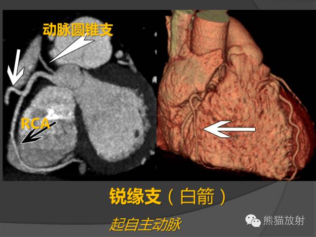 【PPT】冠状动脉解剖 【PPT】冠状动脉解剖