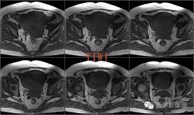 【病例】盆腔小肠间质瘤1例MR影像表现 【病例】盆腔小肠间质瘤1例MR影像表现