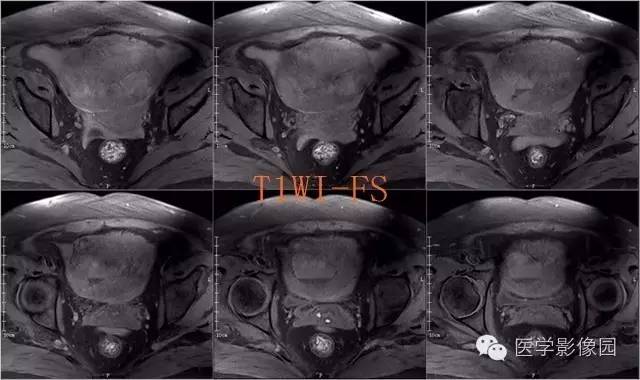 【病例】盆腔小肠间质瘤1例MR影像表现 【病例】盆腔小肠间质瘤1例MR影像表现