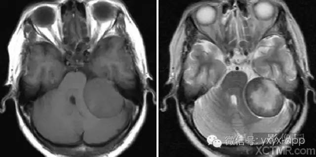 脑膜瘤影像诊断基础、病理分型与MRI特征