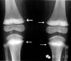 "干骺端致密带"，这个征象提示啥？