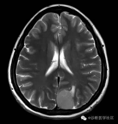 【病例】左侧顶枕叶交界区脑膜瘤1例MR影像表现 【病例】左侧顶枕叶交界区脑膜瘤1例MR影像表现