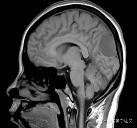 【病例】左侧顶枕叶交界区脑膜瘤1例MR影像表现 【病例】左侧顶枕叶交界区脑膜瘤1例MR影像表现