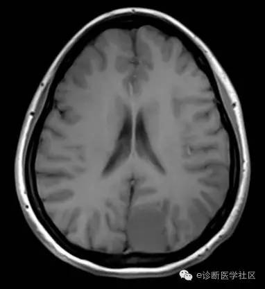 【病例】左侧顶枕叶交界区脑膜瘤1例MR影像表现 【病例】左侧顶枕叶交界区脑膜瘤1例MR影像表现