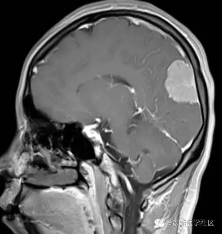 【病例】左侧顶枕叶交界区脑膜瘤1例MR影像表现 【病例】左侧顶枕叶交界区脑膜瘤1例MR影像表现