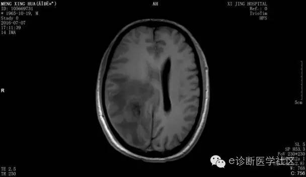 【病例】胶质母细胞瘤1例MR影像表现 【病例】胶质母细胞瘤1例MR影像表现