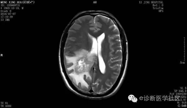 【病例】胶质母细胞瘤1例MR影像表现