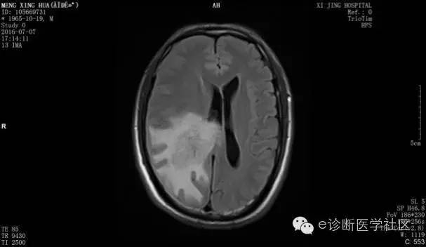 【病例】胶质母细胞瘤1例MR影像表现 【病例】胶质母细胞瘤1例MR影像表现