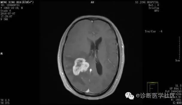 【病例】胶质母细胞瘤1例MR影像表现 【病例】胶质母细胞瘤1例MR影像表现