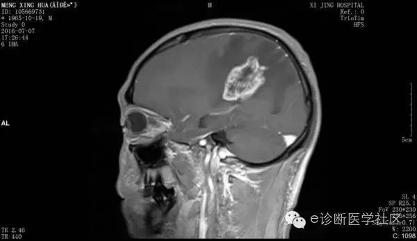 【病例】胶质母细胞瘤1例MR影像表现 【病例】胶质母细胞瘤1例MR影像表现
