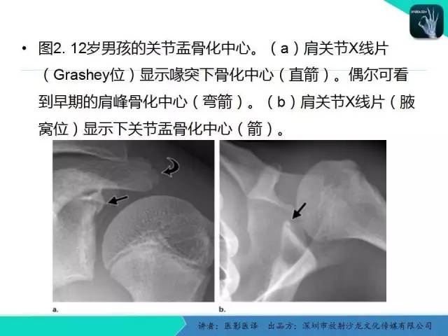 【PPT】儿童肩关节正常骨骼发育和影像诊断陷阱