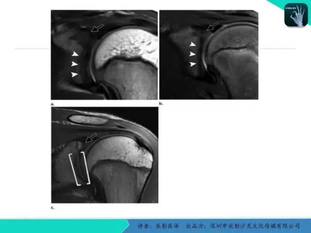 【PPT】儿童肩关节正常骨骼发育和影像诊断陷阱