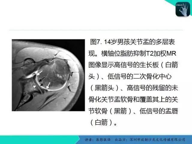【PPT】儿童肩关节正常骨骼发育和影像诊断陷阱