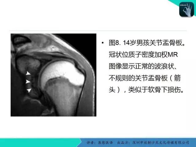 【PPT】儿童肩关节正常骨骼发育和影像诊断陷阱