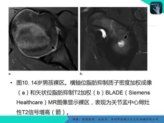 【PPT】儿童肩关节正常骨骼发育和影像诊断陷阱