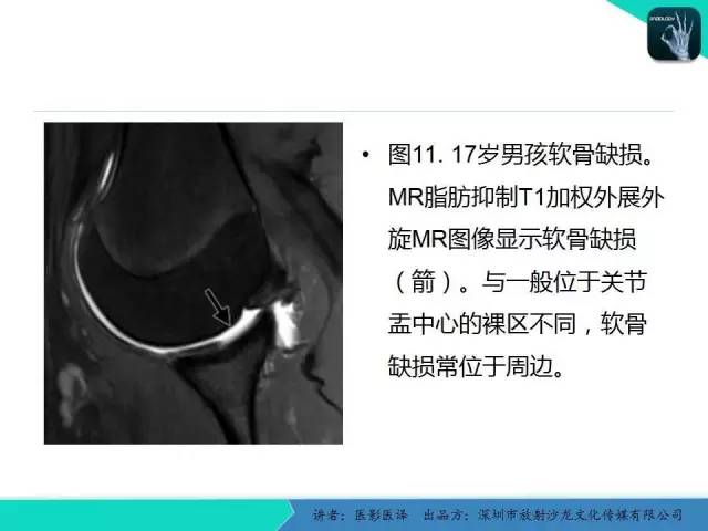 【PPT】儿童肩关节正常骨骼发育和影像诊断陷阱