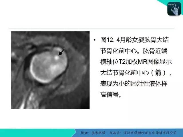 【PPT】儿童肩关节正常骨骼发育和影像诊断陷阱