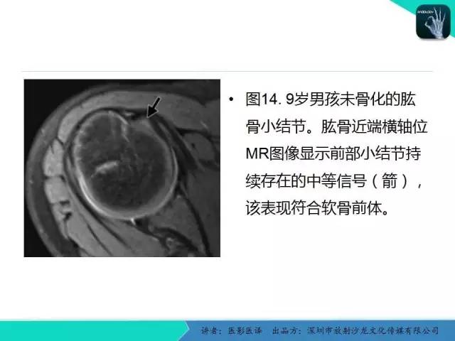 【PPT】儿童肩关节正常骨骼发育和影像诊断陷阱