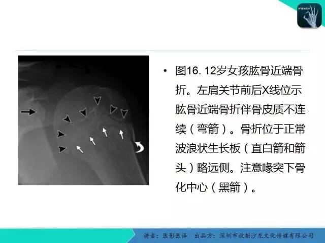 【PPT】儿童肩关节正常骨骼发育和影像诊断陷阱