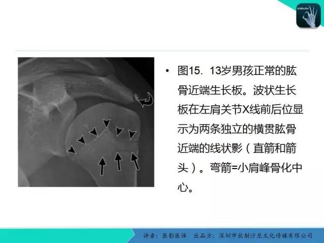 【PPT】儿童肩关节正常骨骼发育和影像诊断陷阱