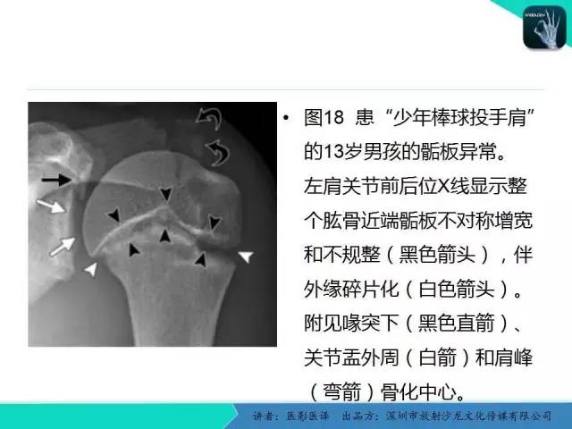 【PPT】儿童肩关节正常骨骼发育和影像诊断陷阱