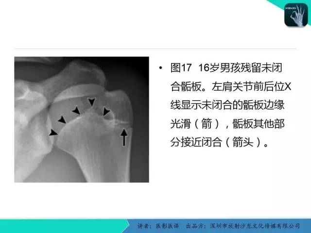 【PPT】儿童肩关节正常骨骼发育和影像诊断陷阱