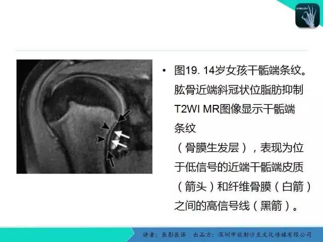 【PPT】儿童肩关节正常骨骼发育和影像诊断陷阱