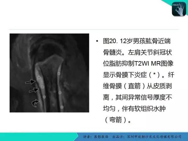 【PPT】儿童肩关节正常骨骼发育和影像诊断陷阱
