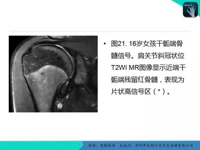 【PPT】儿童肩关节正常骨骼发育和影像诊断陷阱