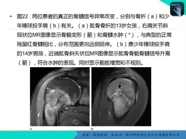 【PPT】儿童肩关节正常骨骼发育和影像诊断陷阱