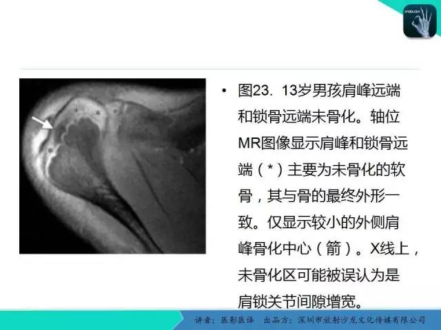【PPT】儿童肩关节正常骨骼发育和影像诊断陷阱
