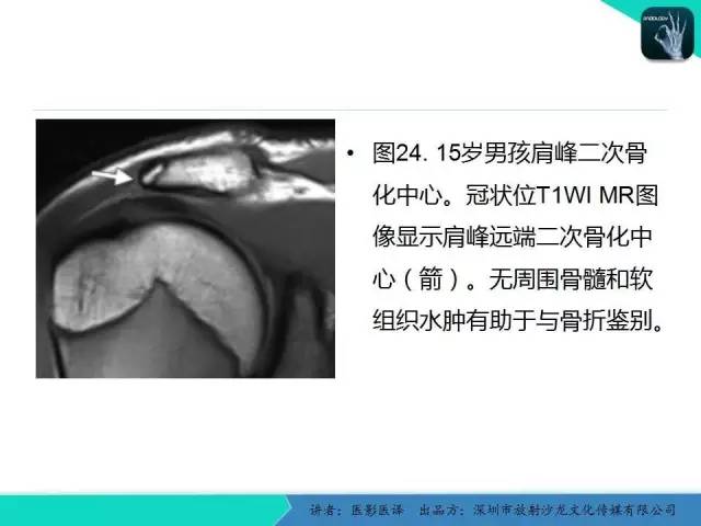 【PPT】儿童肩关节正常骨骼发育和影像诊断陷阱