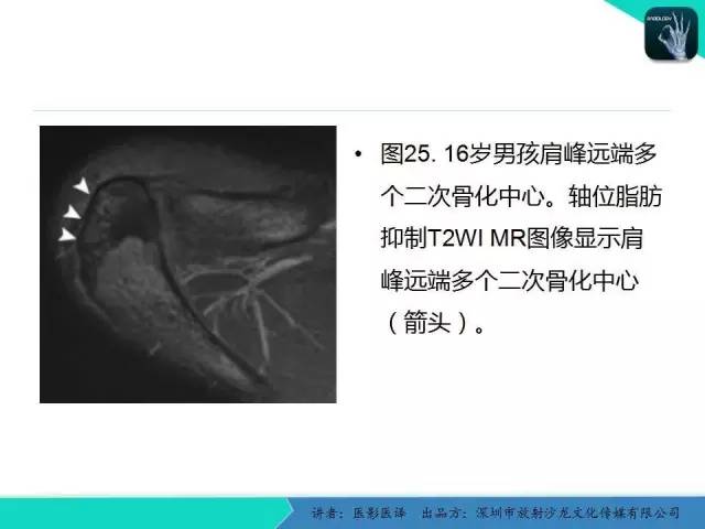 【PPT】儿童肩关节正常骨骼发育和影像诊断陷阱