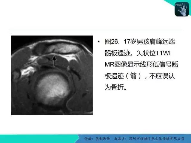 【PPT】儿童肩关节正常骨骼发育和影像诊断陷阱