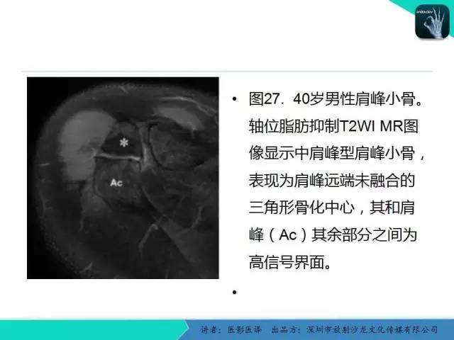【PPT】儿童肩关节正常骨骼发育和影像诊断陷阱