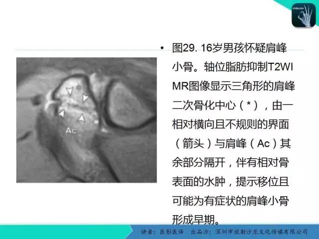 【PPT】儿童肩关节正常骨骼发育和影像诊断陷阱
