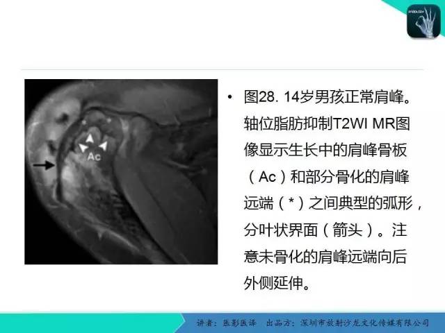 【PPT】儿童肩关节正常骨骼发育和影像诊断陷阱