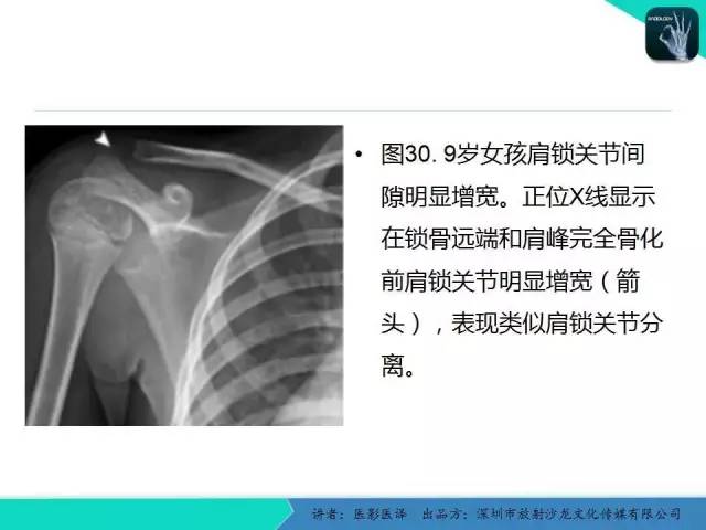【PPT】儿童肩关节正常骨骼发育和影像诊断陷阱