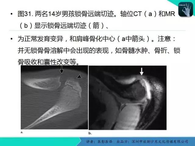 【PPT】儿童肩关节正常骨骼发育和影像诊断陷阱