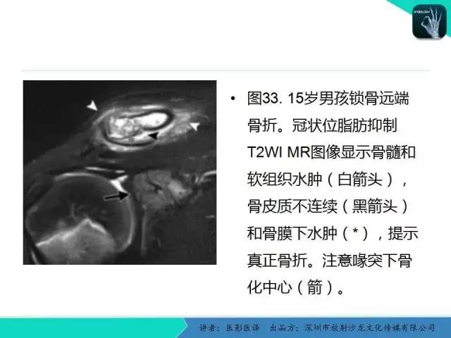 【PPT】儿童肩关节正常骨骼发育和影像诊断陷阱